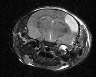 Impact of Bradykinin Generation During Thrombolysis in Ischemic Stroke