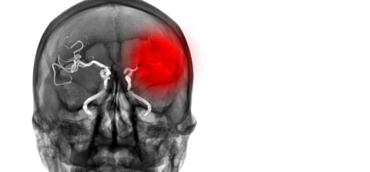 Preclinical models of cerebral haemorrhage